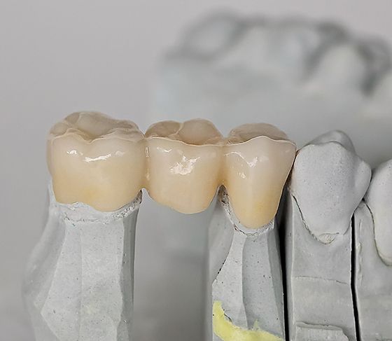 A dental bridge