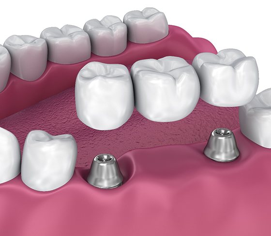 Digital image of an implant bridge