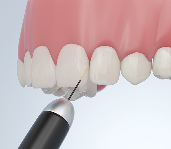 Illustration of a dental laser treating the gums