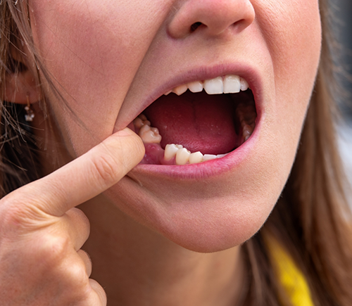 Woman showing off a missing lower tooth
