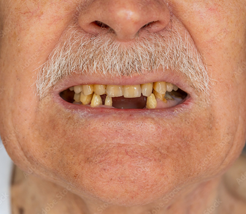 Man missing two front lower teeth
