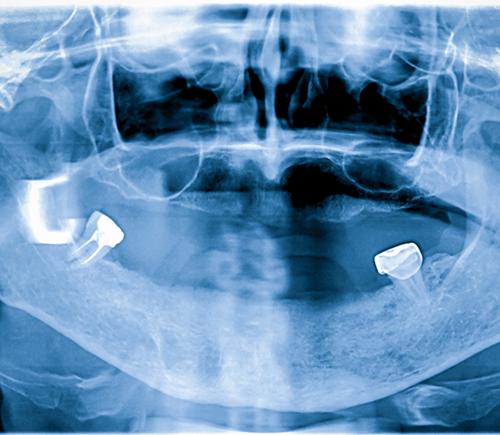 X ray of a person missing all but two teeth