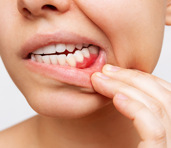 Close up of a person with red gums