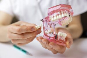 A dentist holding a mouth mold and an implant bridge